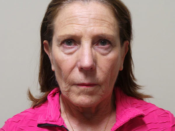 Facelift Patient 08 Before 1