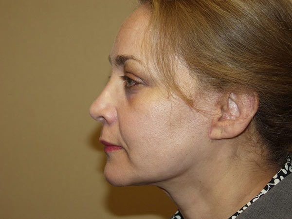 Facelift Patient 10 After 1