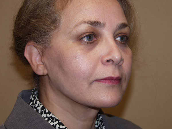 Facelift Patient 10 After 2