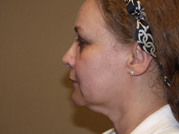 Facelift Patient 10 Before 1