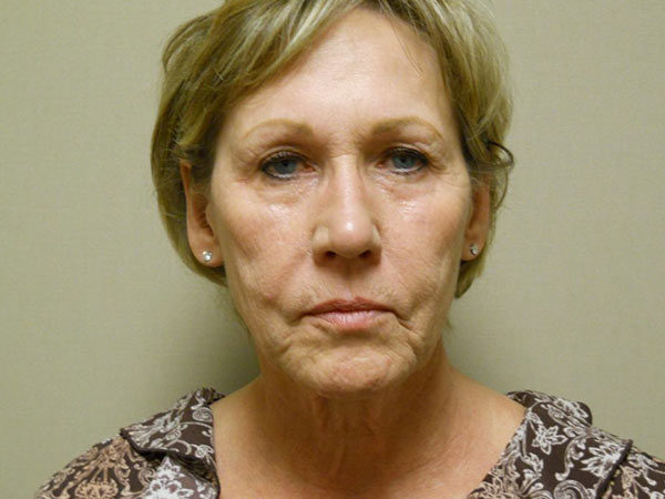 Facelift Patient 12 Before 1