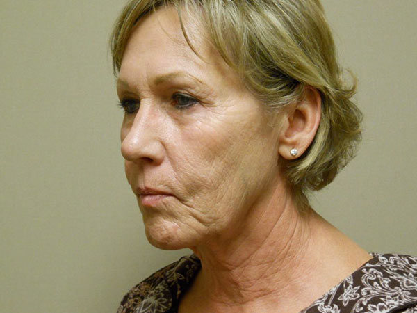 Facelift Patient 12 Before 2