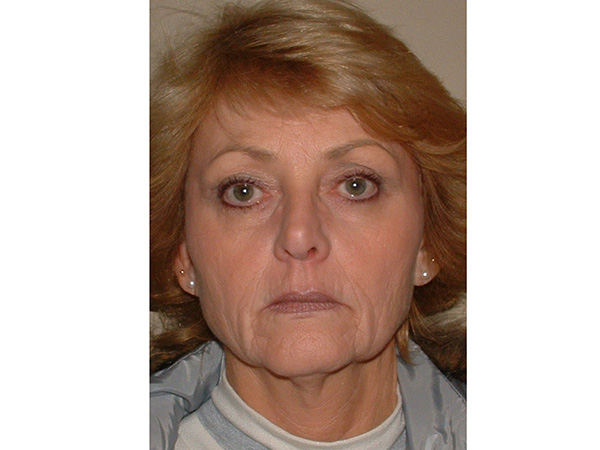 FaceLift Patient 17 Before 1