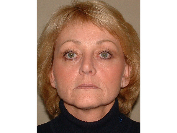 FaceLift Patient 17 After 1