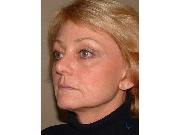 FaceLift Patient 17 After 2