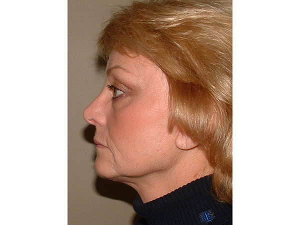 FaceLift Patient 17 After 3
