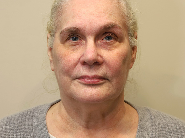 FaceLift Patient 16 Before 1