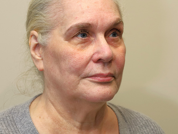 FaceLift Patient 16 Before 2