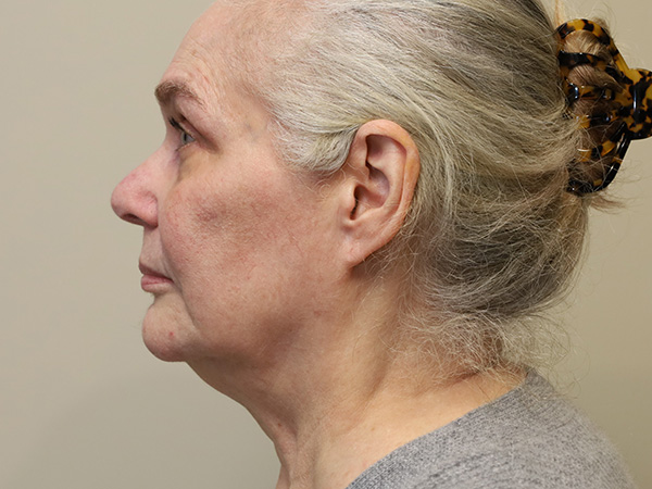 FaceLift Patient 16 Before 3