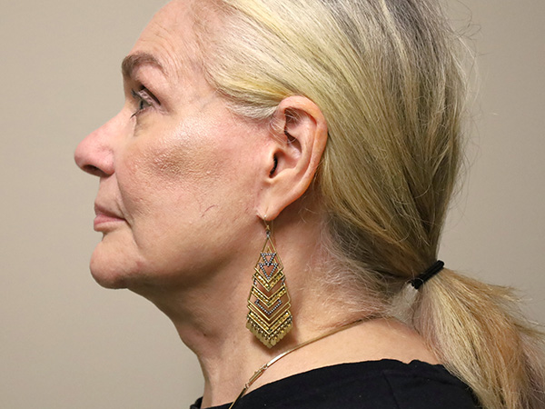 FaceLift Patient 16 After 3