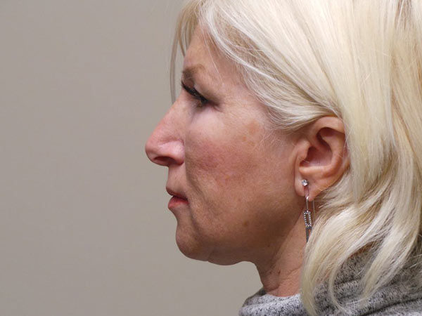 FaceLift Patient 04 Before 1