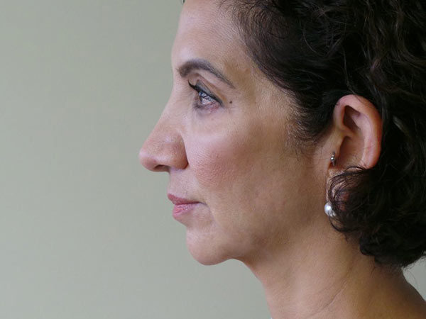 FaceLift Patient 05 After 1