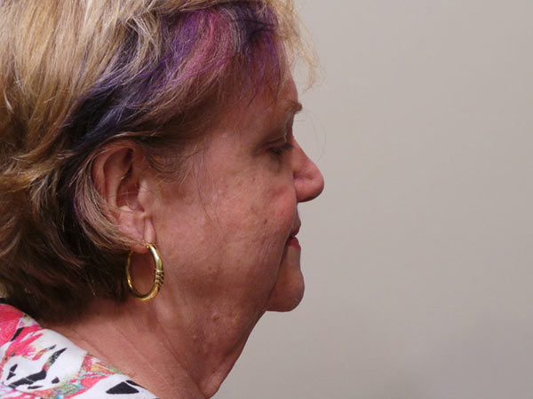 FaceLift Patient 06 Before 1