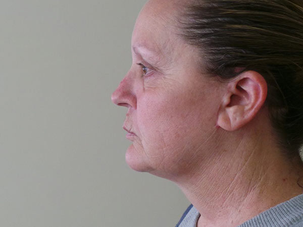 FaceLift Patient 07 After 2