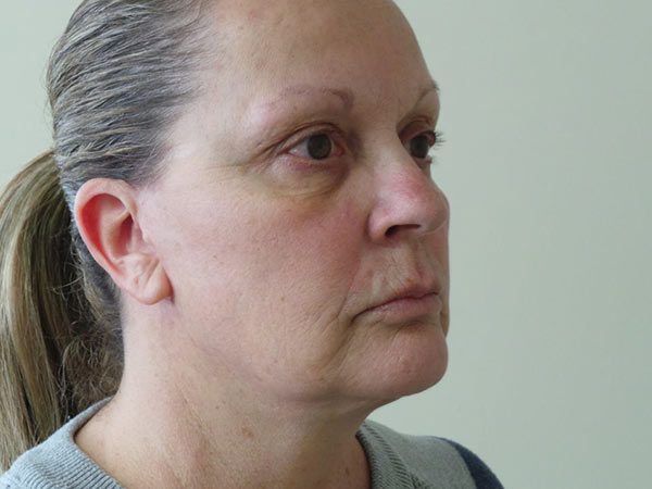 FaceLift Patient 07 After 1