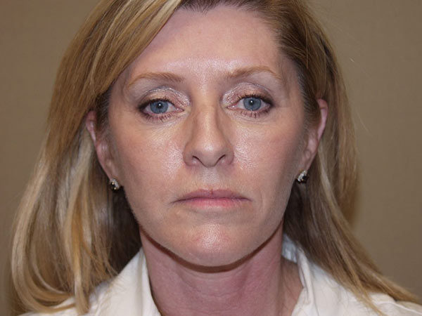 FaceLift Patient 14 After 1