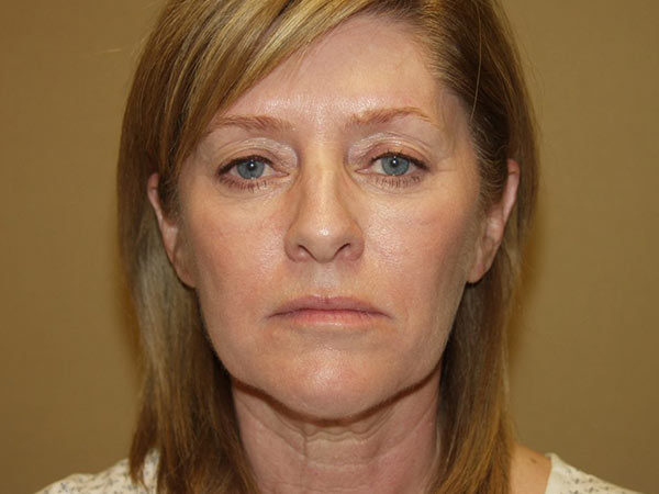 FaceLift Patient 14 Before 1