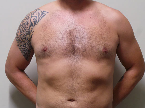 Gynecomastia Patient 01 After 1