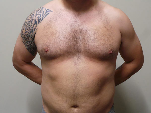 Gynecomastia Patient 01 Before 1