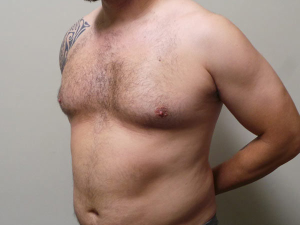 Gynecomastia Patient 01 Before 2