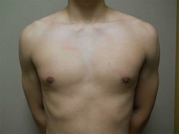 Gynecomastia Patient 09 After 1