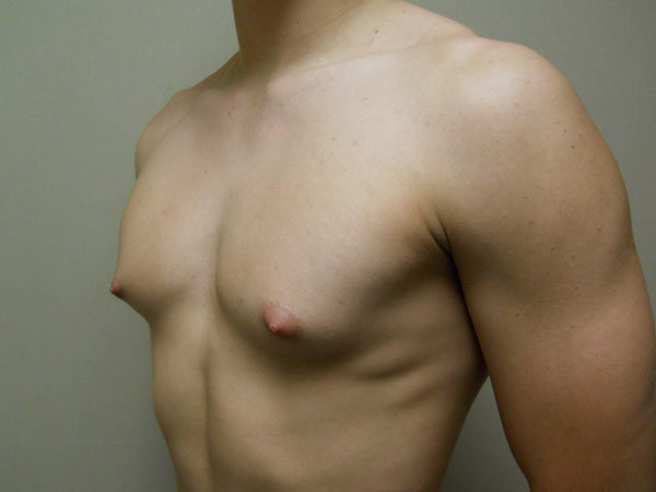 Gynecomastia Patient 09 Before 2