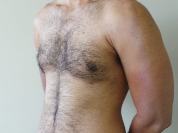 Gynecomastia Patient 10 After 2