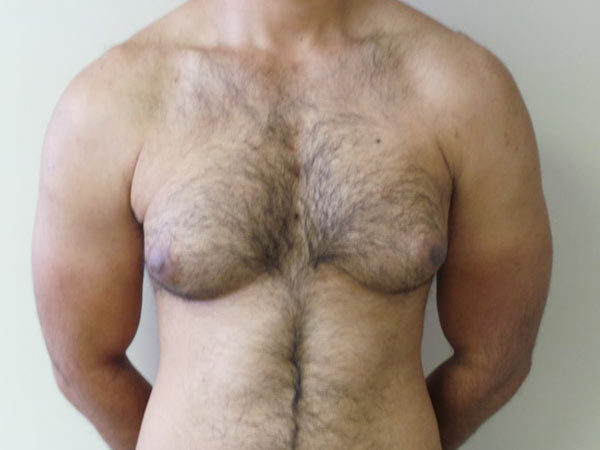 Gynecomastia Patient 10 Before 1