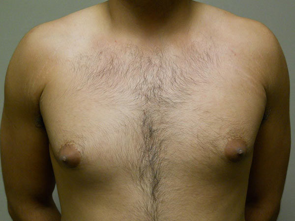 Gynecomastia Patient 11 Before 1