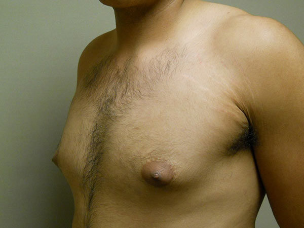 Gynecomastia Patient 11 Before 2