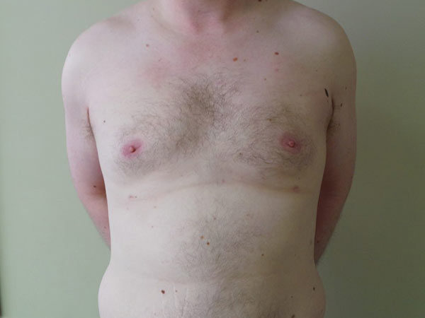 Gynecomastia Patient 03 After 1