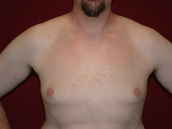 Gynecomastia Patient 04 After 1