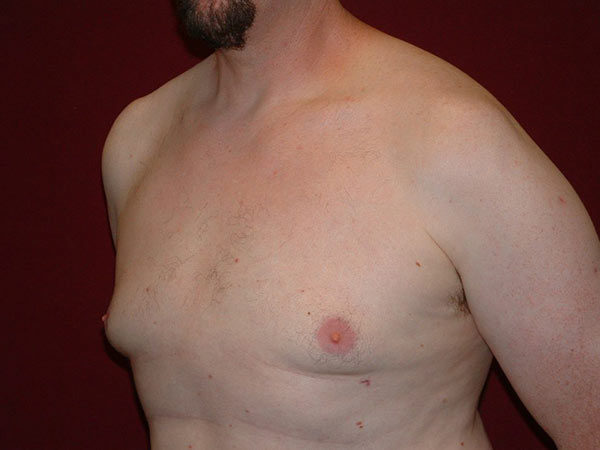Gynecomastia Patient 04 After 2