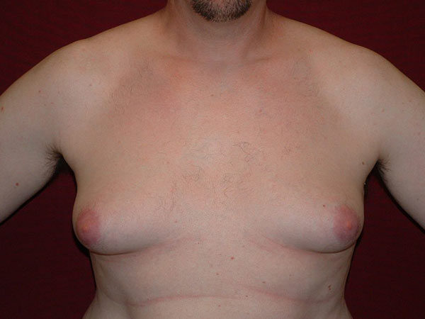Gynecomastia Patient 04 Before 1