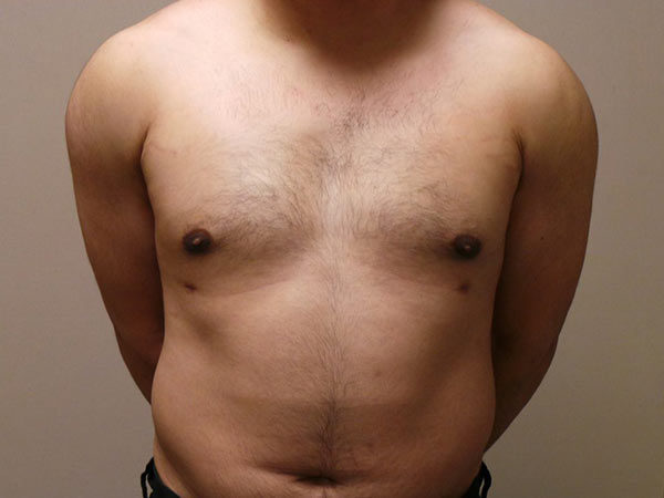 Gynecomastia Patient 05 After 1