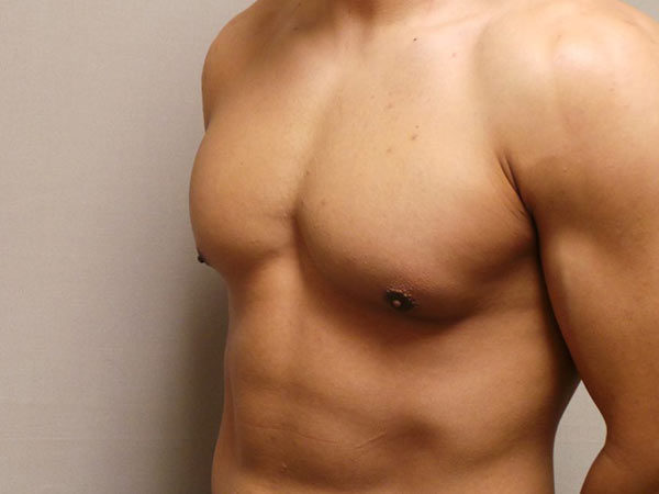 Gynecomastia Patient 07 After 2