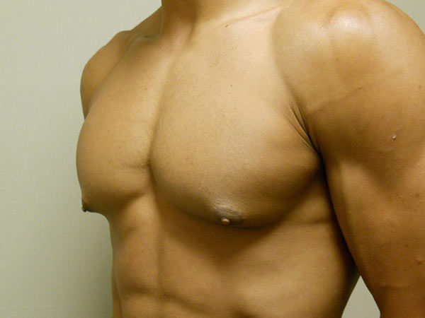 Gynecomastia Patient 07 Before 2