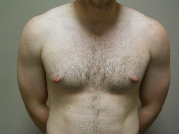 Gynecomastia Patient 08 Before 1