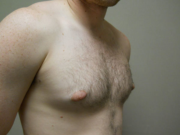 Gynecomastia Patient 08 Before 2