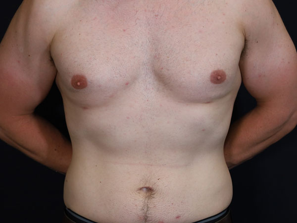Gynecomastia Patient 14 After 1