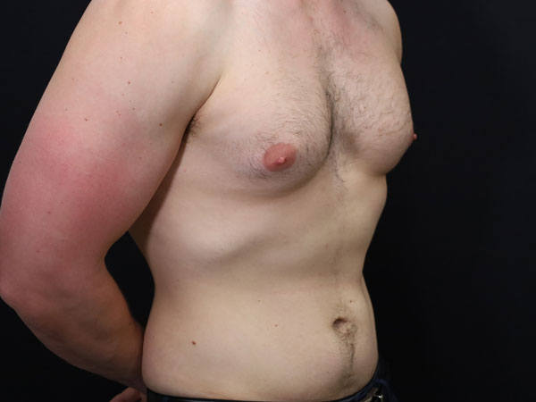 Gynecomastia Patient 14 Before 2