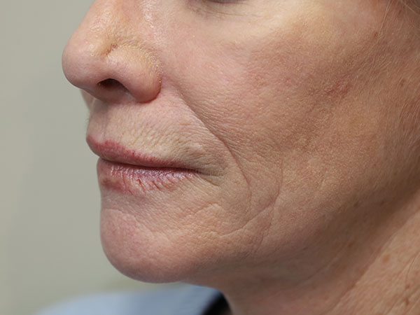 Lip Implant 01 After 2