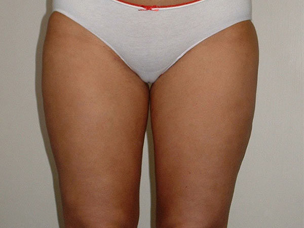 Liposuction Patient 03 Before 1