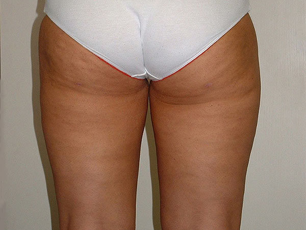 Liposuction Patient 03 Before 2