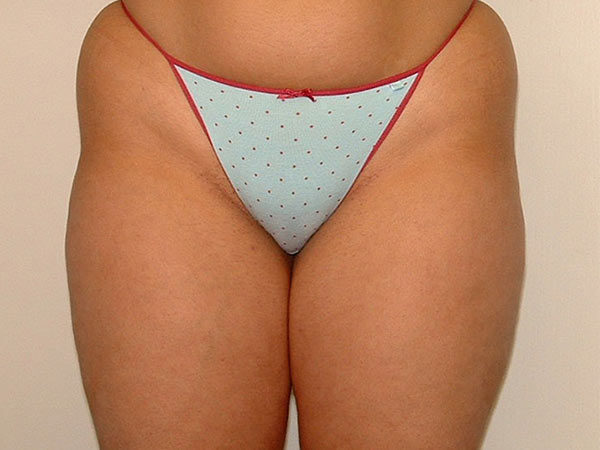 Liposuction Patient 03 After 1