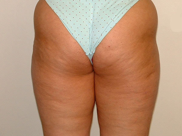 Liposuction Patient 03 After 2