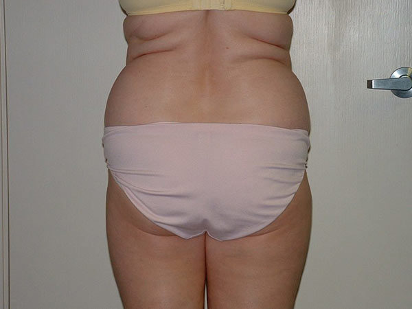 Liposuction Patient 07 Before 1