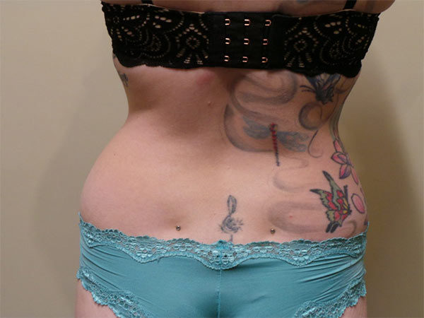 Liposuction Patient 01 Before 2