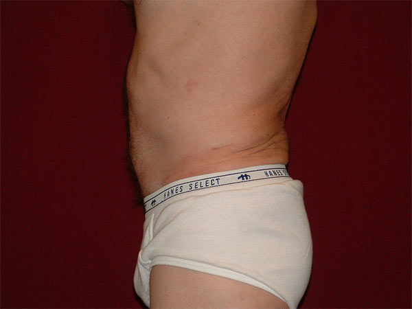 Liposuction Patient 04 After 2