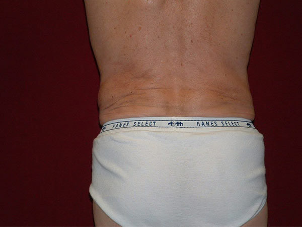 Liposuction Patient 04 After 1